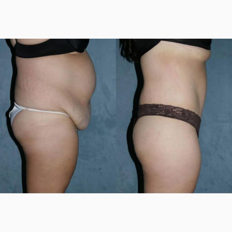 Dr. Jairo Zalamea Silva - Cirugía Plástica