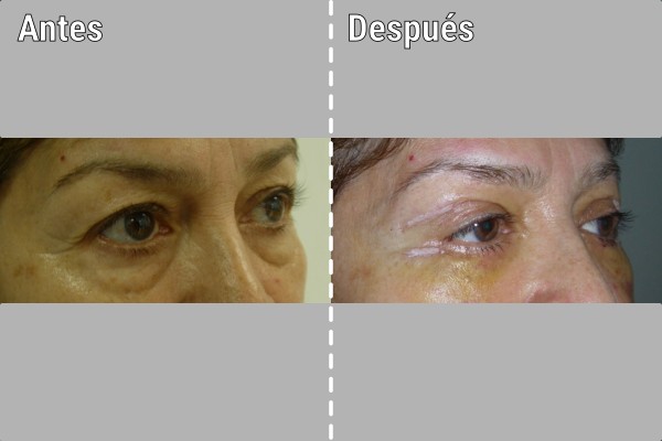 blefaroplastia
