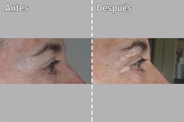 blefaroplastia