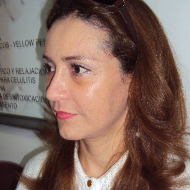 Lipoinyección facial