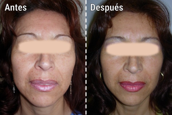 lipoinyeccion-facial