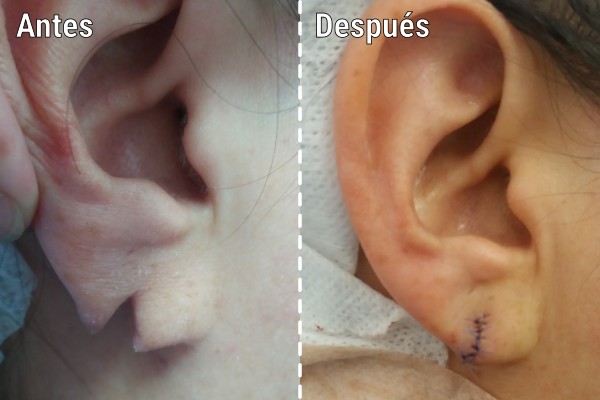 reconstruccion-de-lesiones