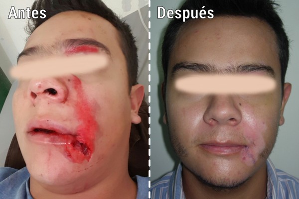 reconstruccion-de-lesiones