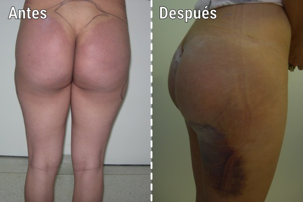 tratamiento-quirurgico-por-biopolimeros